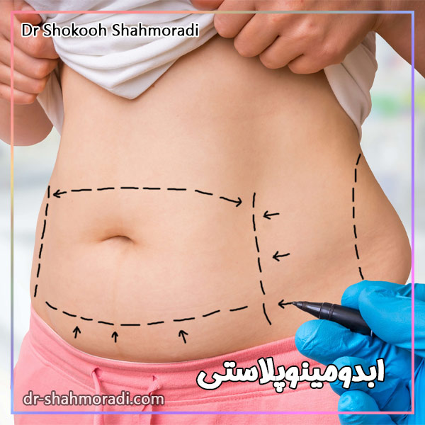 ابدومینو پلاستی - دکتر شکوه شاهمرادی
