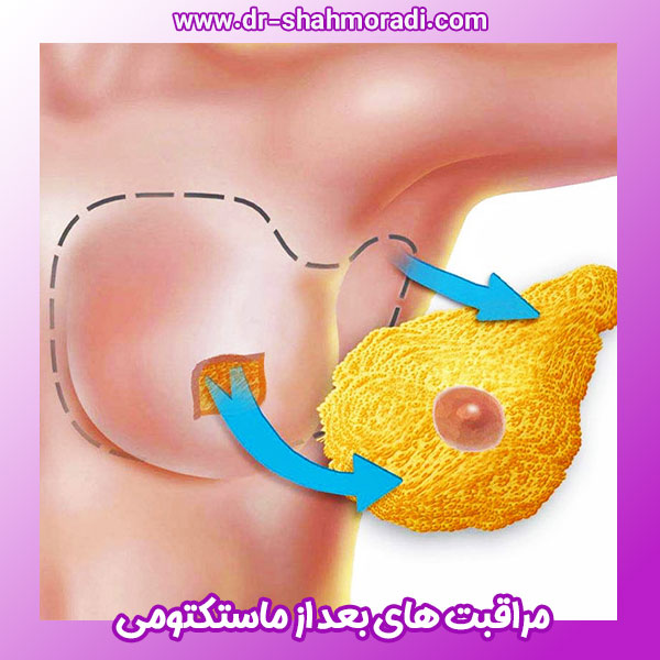 مراقبت های بعد از ماستکتومی