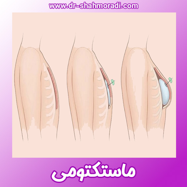 ماستکتومی - https://dr-shahmoradi.com/