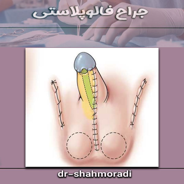 جراح فالوپلاستی از دکتر شکوه شاهمرادی ، بهترین جراح فالوپلاستی در کرچ