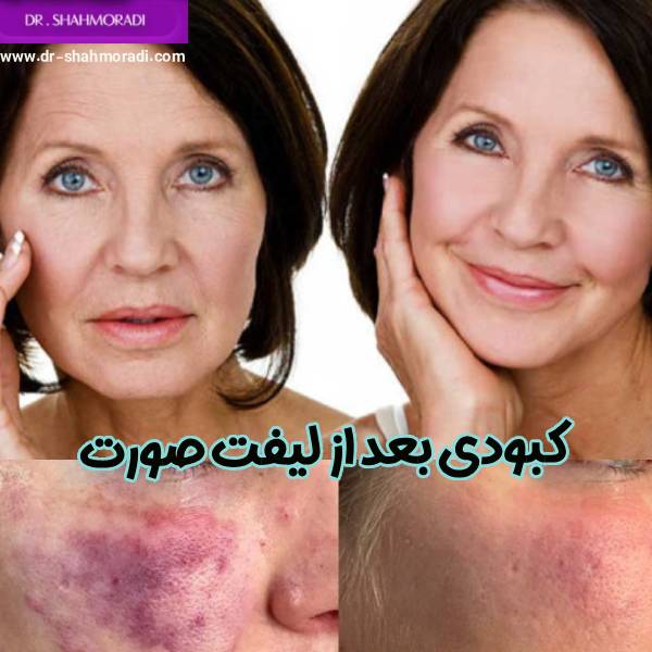 کبودی بعد از لیفت صورت - دکتر شکوه شاهمرادی