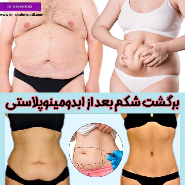 برگشت شکم بعد ابدومینوپلاستی - دکتر شکوه شاهمرادی