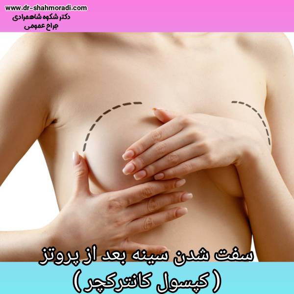 سفت شدن سینه بعد پروتز - دکتر شکوه شاهمرادی