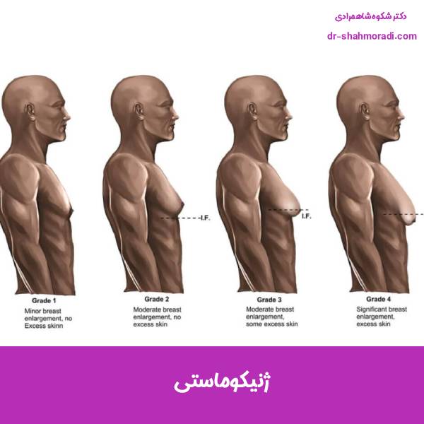 ژنیکوماستی