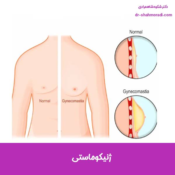 ژنیکوماستی